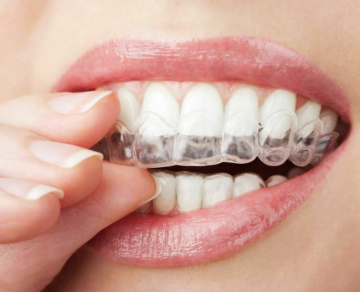 KNOW BEFORE GETTING INVISALIGN